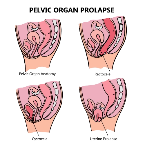 prolapse-Integrity-Rehab-Leander-Austin-Salado-Temple-Burleson-Harker-Heights-Killeen-Copperas-Cove-TX